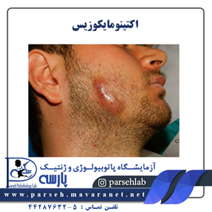 اکتینومایکوزیس