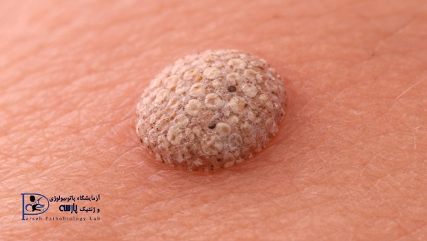 آزمایش ویروس HPV