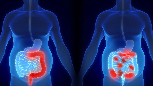 IBD چیست