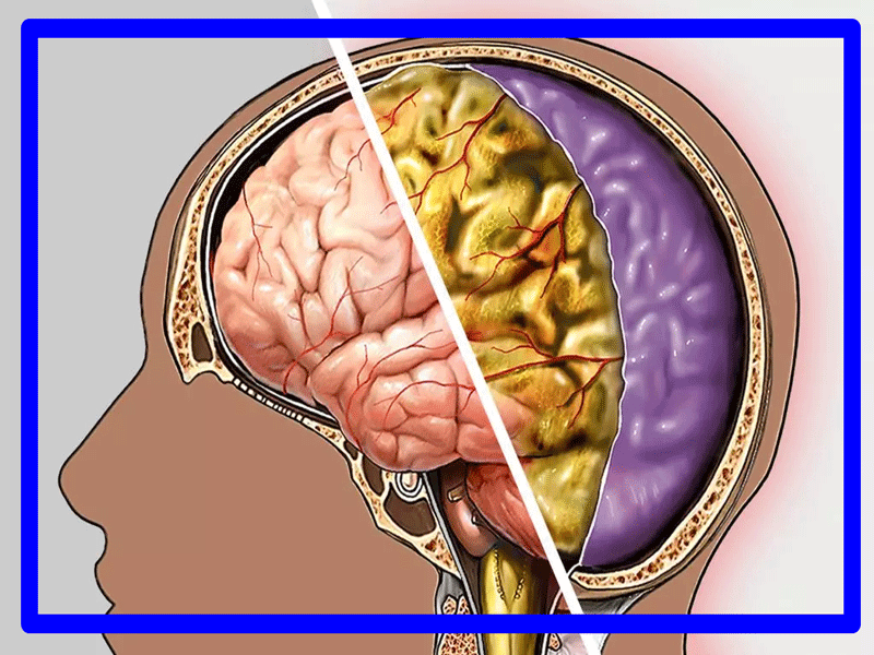 مننژیت قارچی