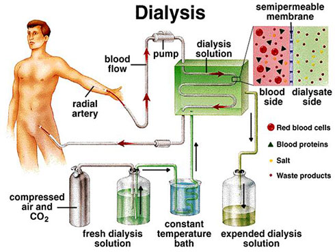dialysis 2