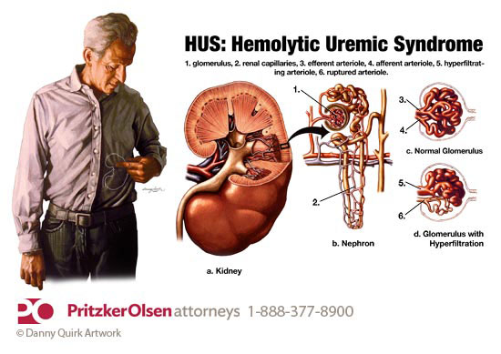 hemolytic uremic syndrome information1