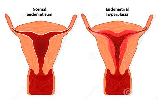 hyperplasia uterus
