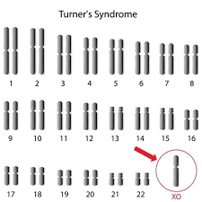 turner syndrome 2