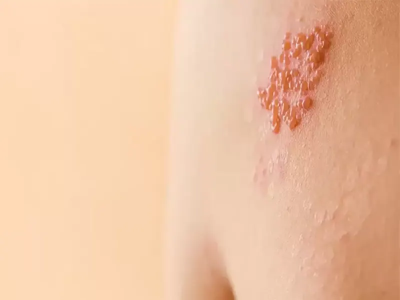 بیماری زونا