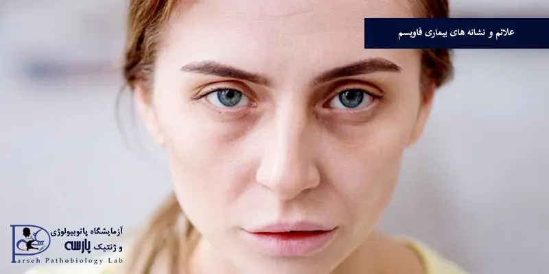 علائم-و-نشانه-های-بیماری-فاویسم